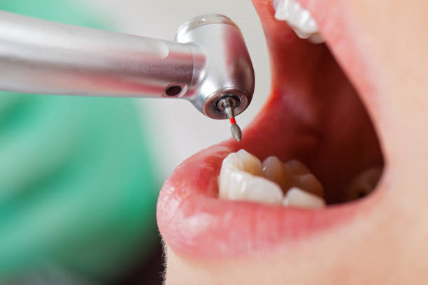 Best Emergency Dental Extractions in Albany, IN
